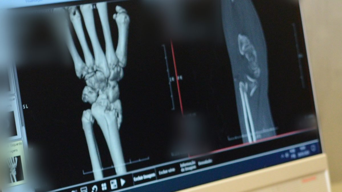Radiografia da mão e do punho na tela do consultório do Dr. Max Lopes Jr